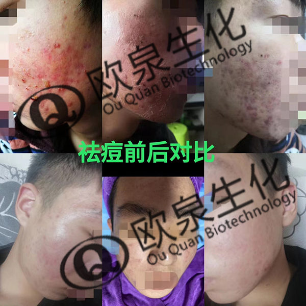 好產品不分距離—祛痘精華液-歐泉生化